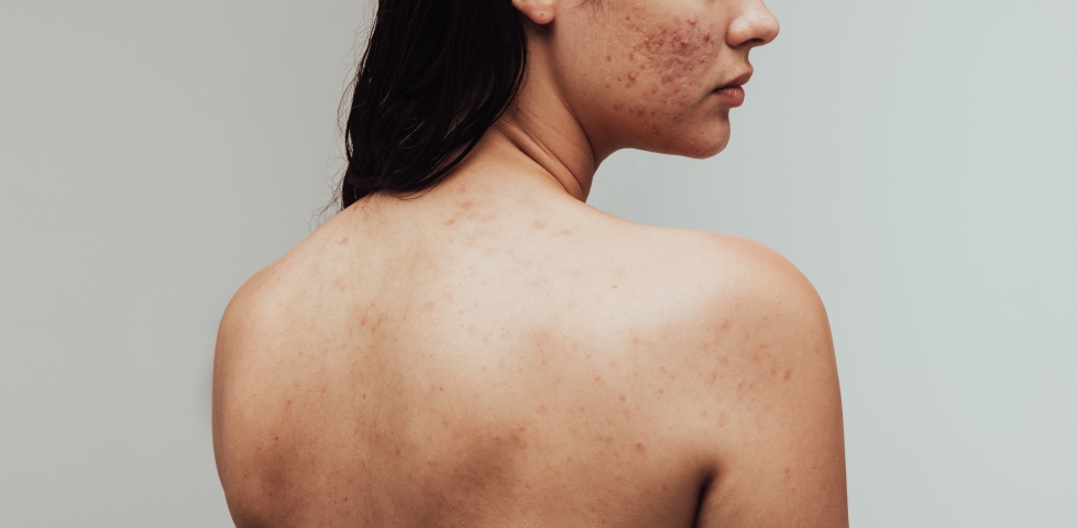 Adult acne – Tips for acne in adults